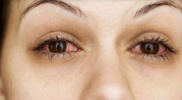 Woman with red, itchy eyes